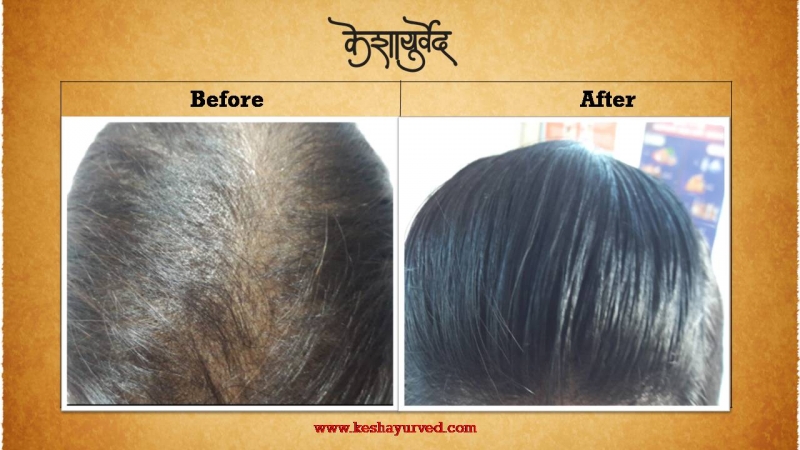 Before After Treatment Result