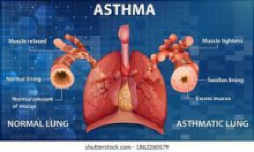 Asthama