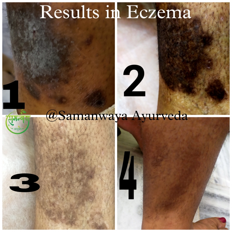 results in dry eczema
